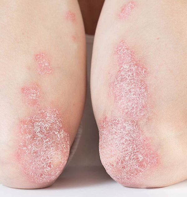 What is psoriasis? Its Causes, Symptoms and Treatment