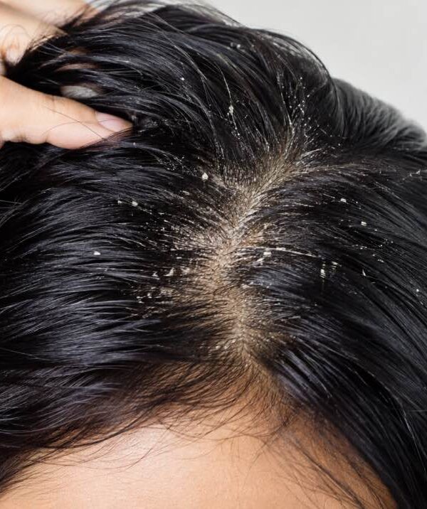 scalp buildup