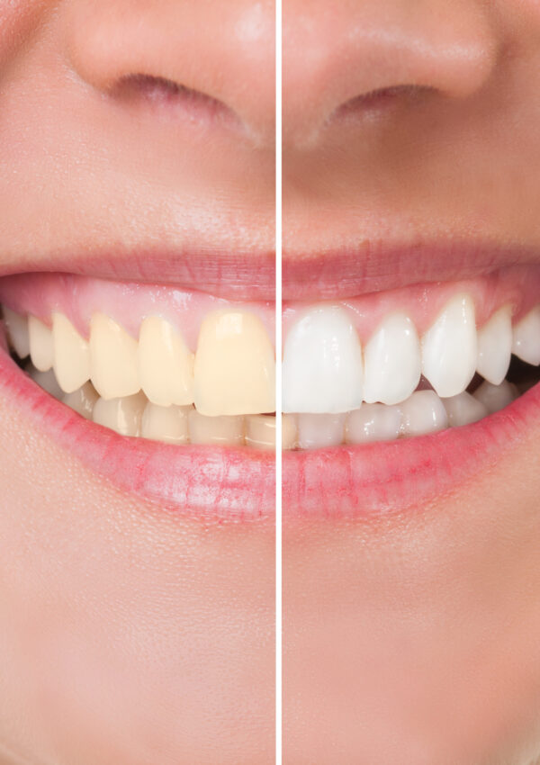 8 Tips for Teeth Whitening at Home