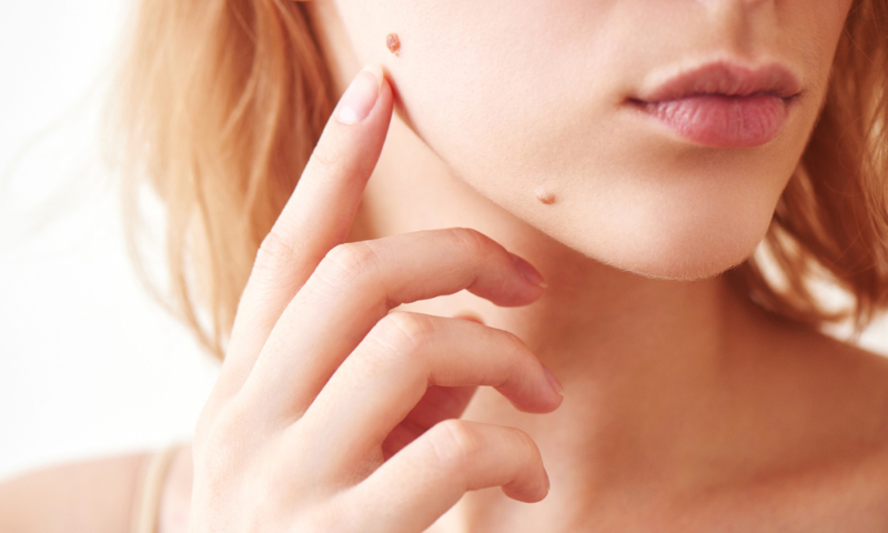 Unveiling Skin Tags: Your Secret Discomfort and Fast Removal Fixes!