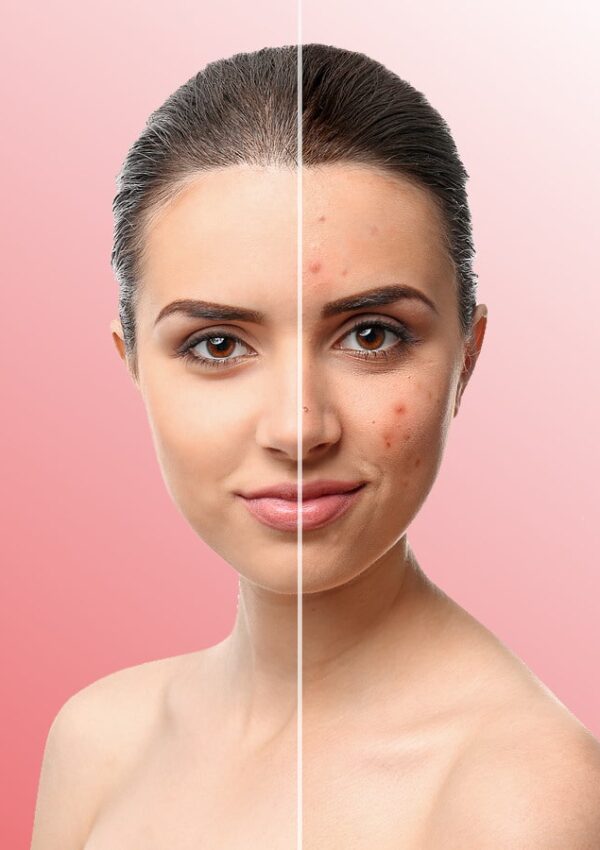Demystifying Acne: Understanding Causes, Remedies, and More